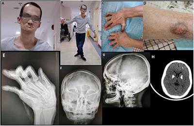 Case Report: Aicardi-Goutières Syndrome and Singleton-Merten Syndrome Caused by a Gain-of-Function Mutation in IFIH1